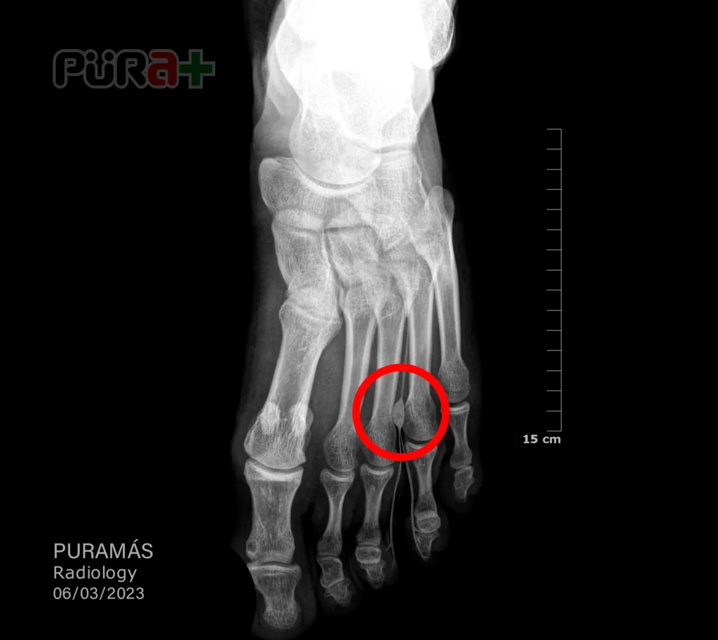 Neuroma de Morton Reina Letizia